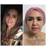 Antes e depois BIoestimulador