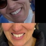 Antes e depois BIoestimulador 2