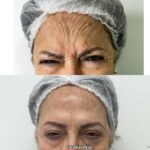 Foto antes e depois Toxina Botulínica 2