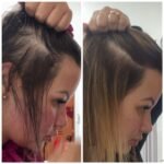 Foto antes e depois - ensima capilar