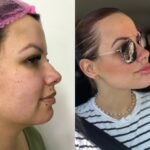 Foto antes e depois - Full face