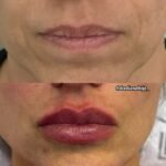 Foto antes e depois - Preenchedor labios