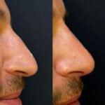 Foto antes e depois - rino 2