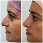 Foto antes e depois - rino e labios