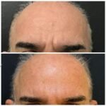 Foto antes e depois Toxina Botulínica